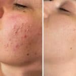 Acne Scars & Dark Marks