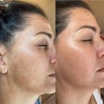 Dull & Dehydrated Skin