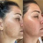 Dull & Dehydrated Skin