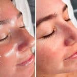 Fine Lines & Early Aging