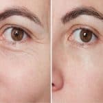 Large Pores & Rough Texture