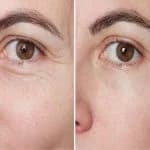 Large Pores & Rough Texture